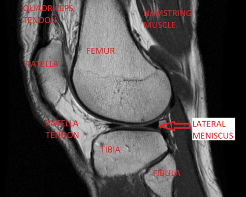 MRI image of the knee from the side.